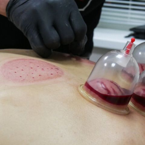 حجام بالرياض|حجامه بالرياض|حجام ممتاز|أفضل حجامة أبوياسين 0535525 8